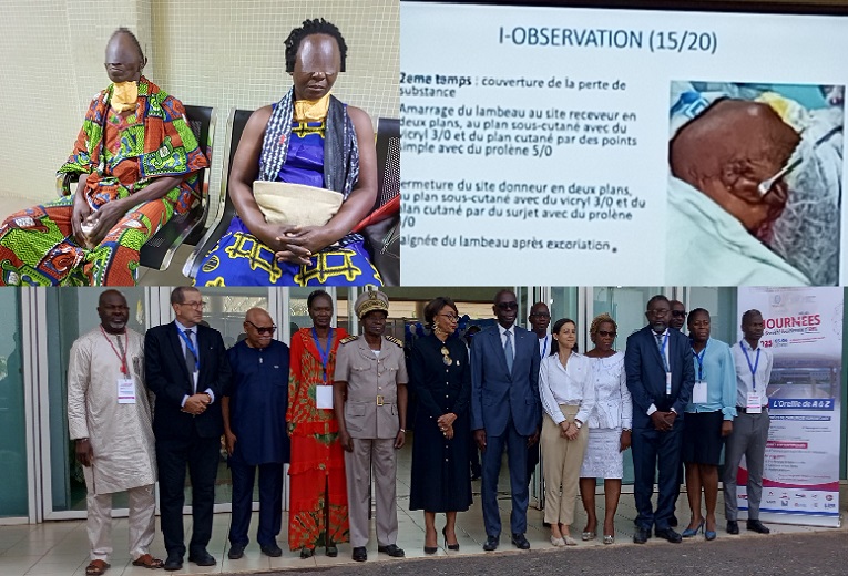 Yamoussoukro-Journées de la société ivoirienne d'ORL : la population dépistée et des malades libérés de leur handicap gratuitement; Ledebativoirien.net